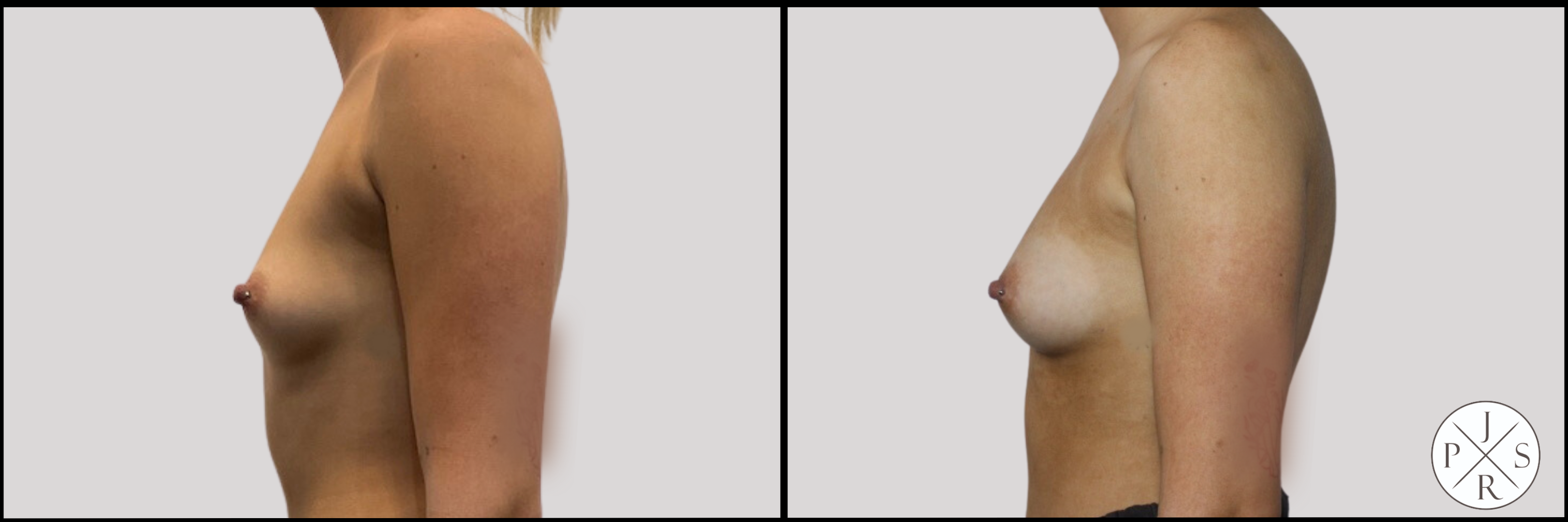 Fat Transfer Breast Augmentation Before & After Image